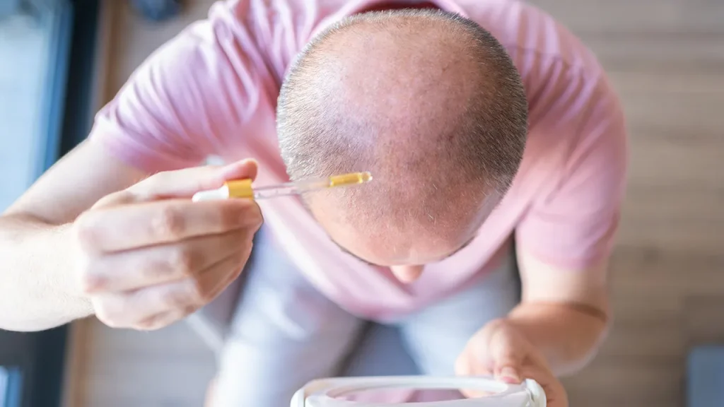 Experimental Serum Demonstrates Promising Results in Reversing Baldness Within 20 Days