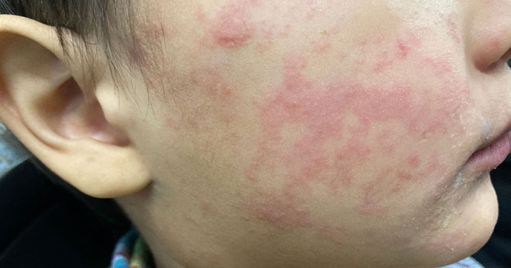 Measles Cases Surge as Experts Point to Misinformation Concerns