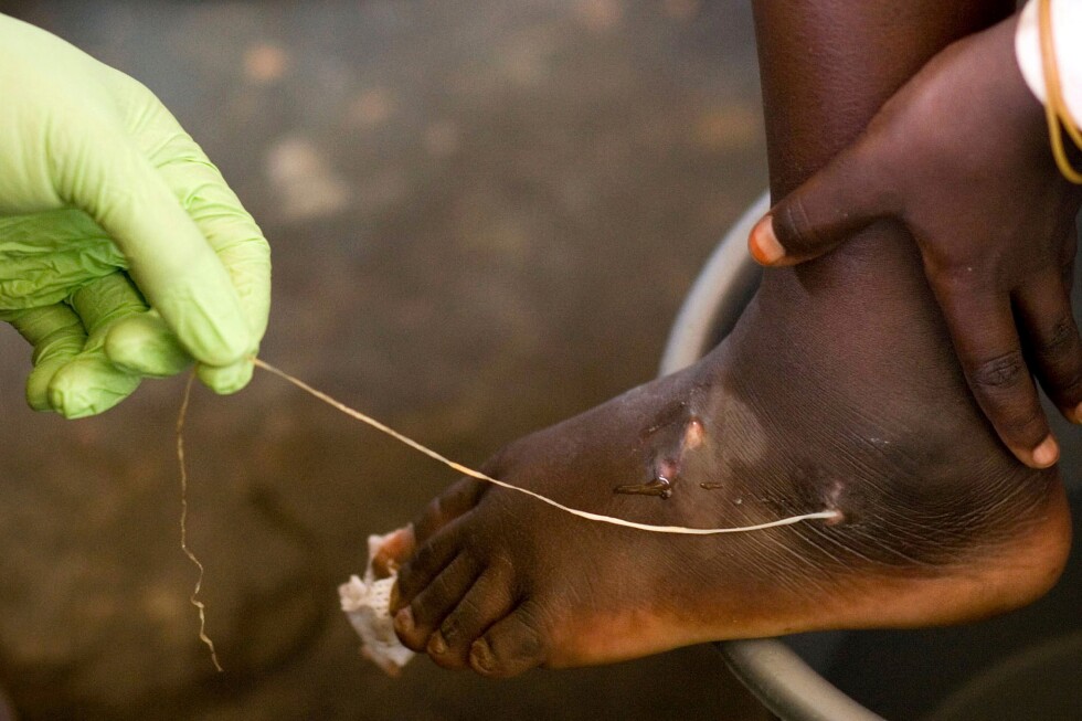 World creeps closer to eradicating human Guinea worm cases, with just 10 last year: Carter Center