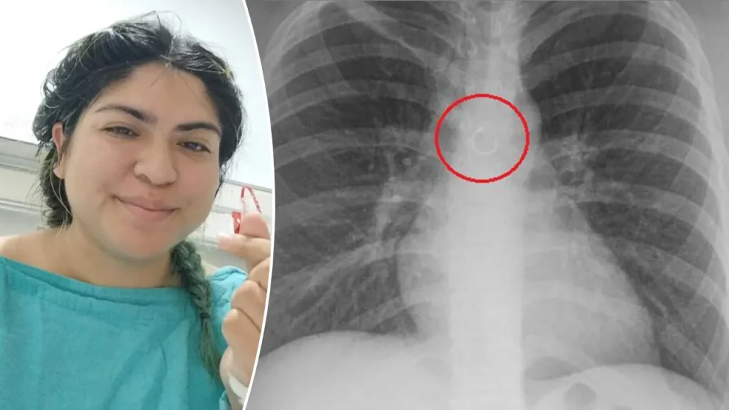 Woman’s Missing Nose Ring Found in Lungs After Month-Long Cough